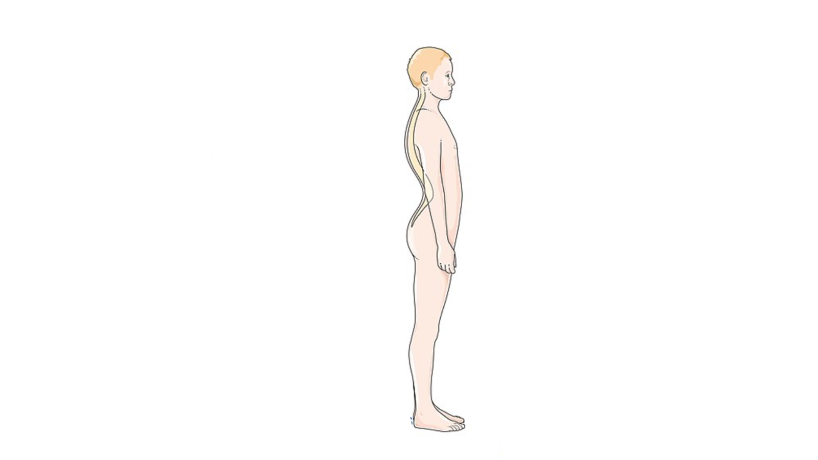 Diagram of person with Lordosis